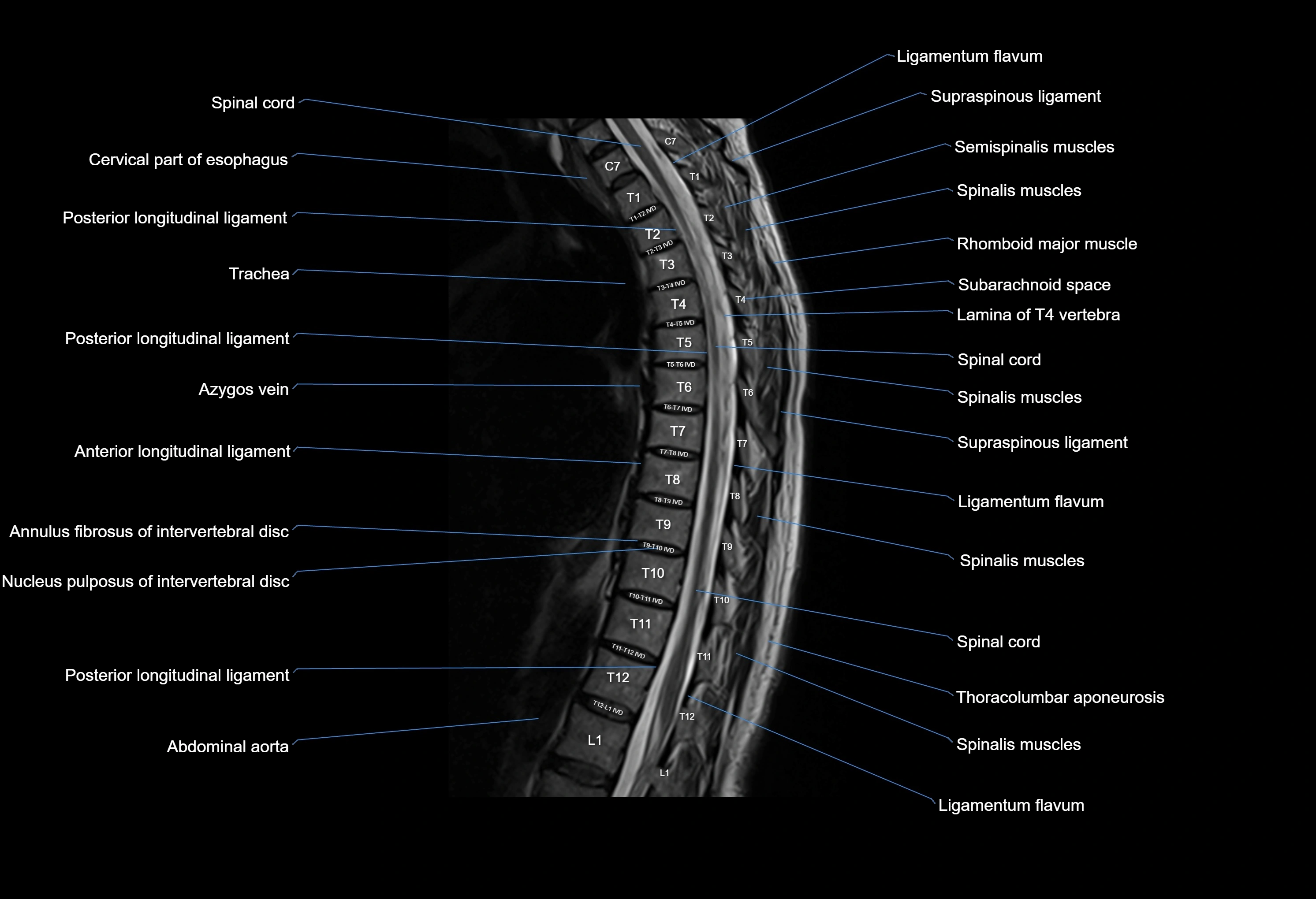 MRI thoracic spine sagittal  cross sectional anatomy 3T radiology  image-img-00001-00014.webp